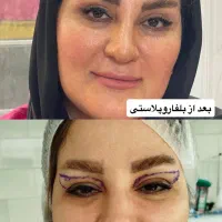 بلفاروپلاستی ، ژل ، بوتاکس|خدمات زیبایی و سلامت|تبریز, |دیوار