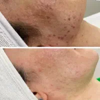 فشیال تخصصی+ اصلاح با بند + درماپلینگ + ابرو  ۳۵۰|خدمات آرایشگری و زیبایی|زاهدان, |دیوار