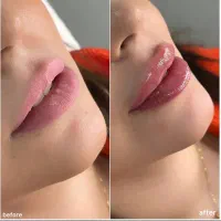 تزریق فیلر بادی کانتورینگ صورت بوتاکس ژل لب|خدمات آرایشگری و زیبایی|تهران, جردن|دیوار