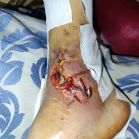 ویزیت تخصصی زخم در منزل-توسط کارشناس مجرب|خدمات آرایشگری و زیبایی|صومعهسرا, |دیوار