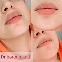 فیلر/ ژل لب تخصصی ۱.۳۰۰ ، بوتاکس پیشانی / لیفت۷۶۰|خدمات آرایشگری و زیبایی|مشهد, هدایت|دیوار