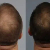 خدمات پی آر پی(PRP)پوست و مو و مزوتراپی اگزوزوم|خدمات آرایشگری و زیبایی|اصفهان, دشتستان|دیوار