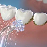 واترجت دندان شارژی ارتودنسی کامپوزیت ایمپلنت