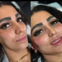 تزریق بوتاکس و فیلر توسط پزشک جراح