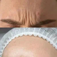 ژل و بوتاکس تضمینی
