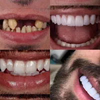 ساخت دندان مصنوعی متحرک دندانسازی