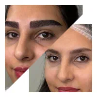 کاشت تخصصی ابرو با تخفیف ویژه محدود