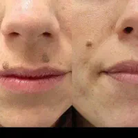 رفع خال و زگیل و زائده گوشتی