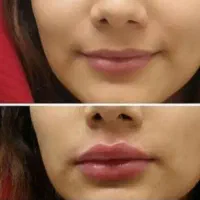تزریق ژل وبوتاکس ژل لب گونه چانه زاویه خط لبخند|خدمات آرایشگری و زیبایی|کرمانشاه, |دیوار