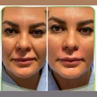 فیلر لب ، خط خنده، زاویه ، مزو فقط ۱۸۰۰|خدمات آرایشگری و زیبایی|محمدیه-قزوین, |دیوار