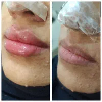 کلینیک ژل آنزیم بینی. لب بوتاکس فیلر و آموزش|خدمات آرایشگری و زیبایی|مشهد, آزادشهر|دیوار