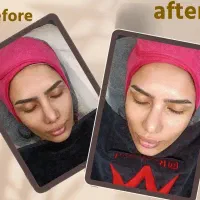 فشیال تخصصی با تخفیف ویژه ـ پاکسازی و آبرسانی پوست