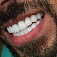 کامپوزیت دندان|خدمات آرایشگری و زیبایی|اردبیل, |دیوار