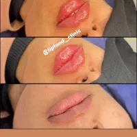 تزریق ژل و بوتاکس