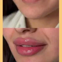 ژل بوتاکس مزو نخ PRP فشیال بادی