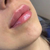 ژل لب متود روسی توسط پزشک حرفه ای|خدمات آرایشگری و زیبایی|حمیدیا, |دیوار