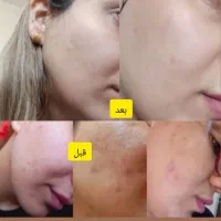 درمان تخصصی جوش های صورت|آرایشی، بهداشتی، درمانی|کرج, شهرک آسمان|دیوار