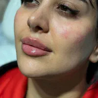 تزریق ژل بوتاکس وانزیم فیلر بینی ۳۹۹|خدمات آرایشگری و زیبایی|تهران, عبدل‌آباد|دیوار