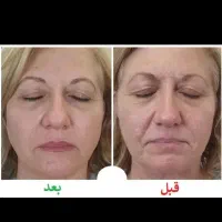 مزوندلینگ ،میکرونیلدینگ و درمان تخصصی لک|خدمات آرایشگری و زیبایی|بیرجند, |دیوار