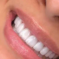 کامپوزیت دندان لمینت ایمکس جشنواره بهاره