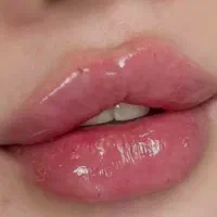 تزریق فیلر (ژل) و بوتاکس