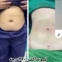ساکشن شکم پهلو توسط دکتری مجرب فقط ۱۵ تومن