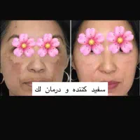 گلوتاتیون/درمان پیسی/روشن کننده کل صورت وبدن|خدمات آرایشگری و زیبایی|اهواز, کیانپارس |دیوار