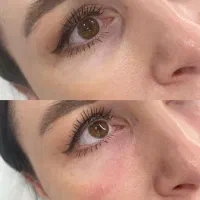 آموزش تزریق ژل و بوتاکس