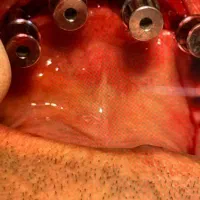 ایمپلنت ارتودنسی لمینت کامپوزیت|خدمات آرایشگری و زیبایی|مشهد, دوست آباد|دیوار