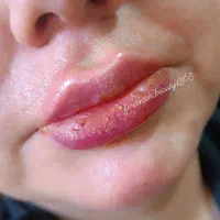 خدمات تزریق فیلر صورت بوتاکس مزوتراپی ولیزر|خدمات آرایشگری و زیبایی|نسیم‌شهر, |دیوار