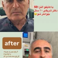 تخفیف لیزر فول بادی۵۱۹،بیشترین جوابدهی|خدمات آرایشگری و زیبایی|سقز, |دیوار