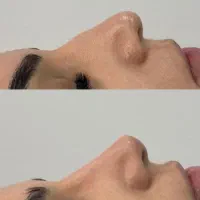 تزریق ژل و بوتاکس و‌پی آرپی لیفت صورت و اصلاح بینی