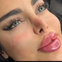 تخفیفات شب یلدا لبروسی، مادلینگ ، بوتاکس، ژل