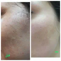 لیزرموزائد، پی آر پی، ریموتتو، فیلر، بوتاکس|خدمات آرایشگری و زیبایی|خوانسار, |دیوار