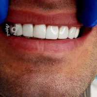 انجام کامپوزیت ونیر با بهترین متریال با افر ۶۰٪|خدمات آرایشگری و زیبایی|بابل, |دیوار