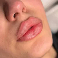تزریق ژل و بوتاکس مزوتراپی پی‌آر‌پی