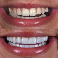 لبخندی رویایی با متریال برند های برتر کامپوزیت