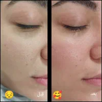 فیشیال پاکسازی بانوان تخفیف ویژه