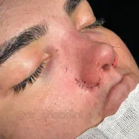 جراحی بینی فقط 45اهواز انجام میشه