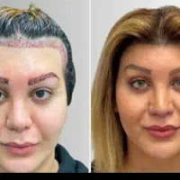 کاشت مو و ابروی طبیعی مزو و پی آرپی جلوگیری ریش مو