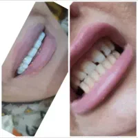 روکش دندان وکامپوزیت وپر کردن