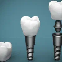 ایمپلنت دندان سوئیسی|آرایشی، بهداشتی، درمانی|تهران, قیطریه|دیوار