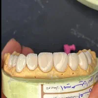 تخفیف ویژه ویژه ویژه روکش|خدمات آرایشگری و زیبایی|تهران, جوادیه|دیوار