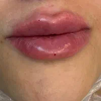 تزریق فیلر لب چانه زاویه فک گونه شقیقه بوتاکس|خدمات آرایشگری و زیبایی|قزوین, |دیوار