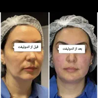 پکیج اقتصادی جوانسازی و لیفت اندوهایفو دکتر داریوش|خدمات آرایشگری و زیبایی|مشهد, راهنمایی|دیوار