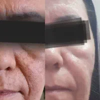 درمان اسکاروجای جوش