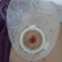 تعویض کیسه های کلوستومی