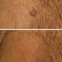 رفع دائمی و قطعی زگیل و‌تبخال تناسلی