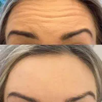 آف ژل بوتاکس مناسبت روز زن