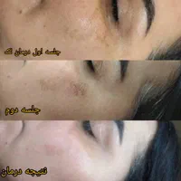 درمان تخصصی پوست و خالبرداری|خدمات آرایشگری و زیبایی|فولادشهر, B2|دیوار